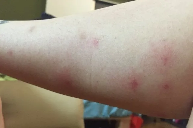Insect bites